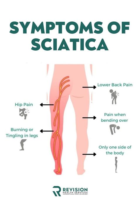 Sciatica refers to pain that radiates along the path of the sciatic nerve, which the sciatica nerve originates in the lower back and runs through your buttock, back of the thigh and down your leg. Are your experiencing Sciatica? Let's find out more about it! Exercise For Back Pain, Back Pain Exercise, Exercise For Back, Neck Pain Exercises, Sciatica Symptoms, Piriformis Stretch, Piriformis Syndrome, Face Yoga Exercises, Sciatica Pain Relief