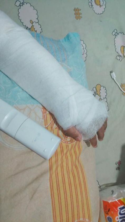 Fracture Hand Plaster Girl, Hand Plaster Fracture Snap, Hand Plaster Fracture, Fracture Hand Snapchat, Accident Hand Dpz, Hand Fracture Pics, Fracture Hand, Hand Fracture, Funny Images With Quotes