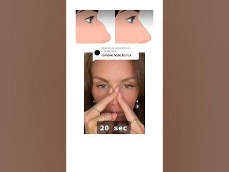 How to Remove a Nose Bump: Tips and Tricks for a Smoother Face #medical #skincare #nose Nose Bump, Medical Skincare, Skincare Facts, Smooth Face, The Bump, Clean Beauty, Bump, Tips And Tricks, Medical