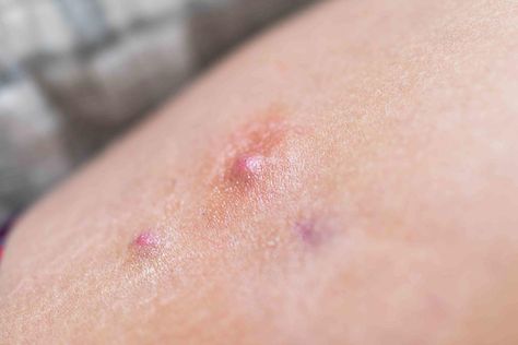 Why Would a Boil Grow on Your Inner Thigh-And What Can You Do About It? Inner Thigh Boils, Squamous Cell, Lymph Drainage, Laser Surgery, Severe Acne, Sweat Gland, Cleveland Clinic, Scar Tissue, Skin Diseases