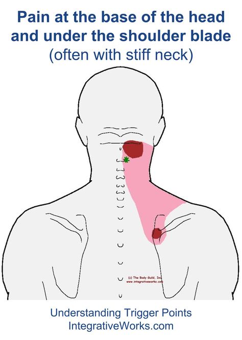 Understanding Trigger Points - Pain at the Base of the Head and Under Shoulder Blade Punkty Spustowe, Excellent Health, Stiff Neck, Upper Back Pain, Neck And Shoulder Pain, Headache Relief, Trigger Points, Shoulder Pain, Reflexology