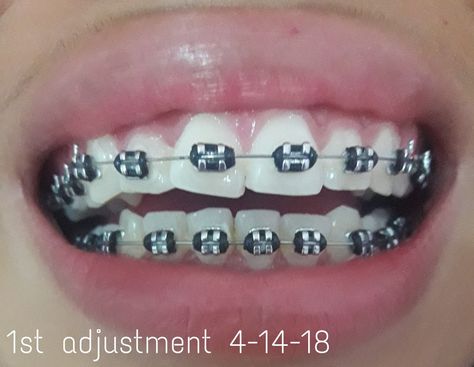 braces health aesthetic brace bracing braces cost braces for teeth bracee teeth braces teeth bracers teeth braces colors braces near me braces for straight teeth braces for teeths braces on teeth braces aesthetic brace color ideas braces colors ideas cute healthy recipes healthy cooking healthy supers healthy cook recipes healthy and delicious healthy food healthy lifestyle healthy snack healthy eats teeth whitener teeth jewelry teeth whitening with braces teeth smile teeth gems teeth color Braces With Black Bands, Braces Black Bands, Black Braces Color, Black Braces Power Chain, Black Braces Teeth, Black Braces Bands, Braces Colors Ideas Cute, Light Blue Braces, Power Chain Braces