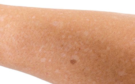 White Spots On Face: Types, Causes, Symptoms & Treatments – Vedix White Spots On Face, White Skin Patches, White Skin Spots, Redness Pimple, Natural Antifungal, Face Types, Spots On Legs, Skin Spots, Spots On Face