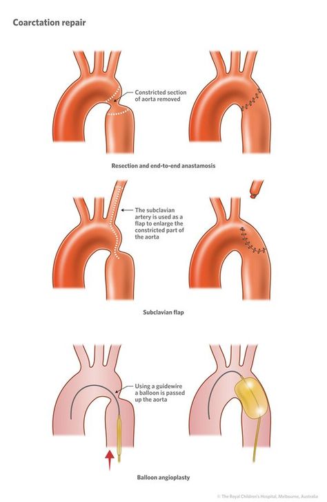 Coarctation Of The Aorta, Cardiac Sonography, Chd Awareness, Congenital Heart Defect, Cardiac Nursing, Congenital Heart, Respiratory Therapy, Health Routine, Nursing Tips