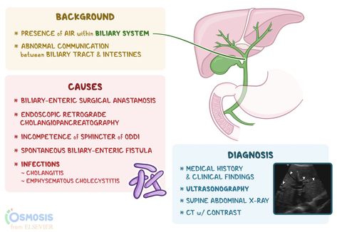 Pneumobilia, also known as aerobilia, refers to the presence of air within the biliary system (i Whipple Procedure, Clostridium Perfringens, Gi System, Septic Shock, Abdominal Discomfort, Bile Duct, Gi Tract, Medical Information, Medical History