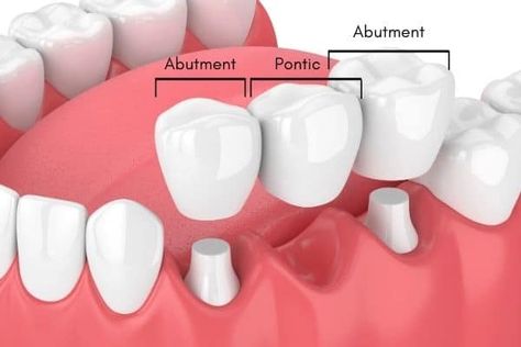 How To Care For Your Dental Bridge - Dental Studio Tooth Bridge, Abscess Tooth, Dental Animation, Dental Studio, Water Pick, Medical Animation, Dental Plaque, Fake Teeth, Tooth Replacement