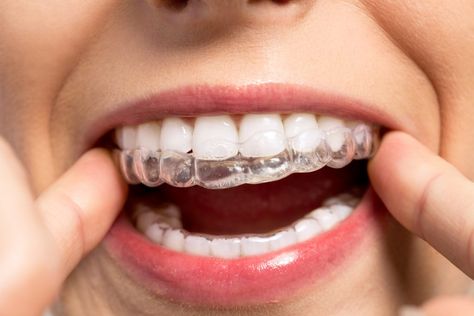 Narrow Smiles & Arches: How We Can Fix & Broaden - The Perfect Smile Uses For Listerine, Invisalign Braces, Skin Transformation, Clear Braces, Clear Aligners, Straight Teeth, Emergency Dentist, Dental Crowns, Smile Makeover