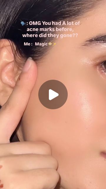 Zarnab🤍 | Yes its true , Acne marks ko ap hamesha k leay by by kr skty and can get glass skin , srf remedies use kr k😍♥️✨  I started series of daily... | Instagram Homemade Remedy For Acne, Remedies For Acne Marks, Products For Acne Marks, How To Remove Acne Marks, Acne Marks Remedies, Acne Pictures, Pimples On Scalp, Acne Prone Skin Care Routine, Get Glass Skin