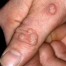 Duct Tape to remove warts Home Remedies For Warts, Warts Remedy, Effective Diet, Holistic Nutrition, Homemade Remedies, Natural Health Remedies, Fitness Planner, Natural Home Remedies, Natural Medicine