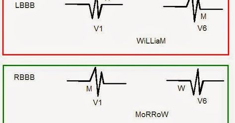 You can distinguish between LBBB (Left Bundle Branch Block) and RBBB (Right Bundle Branch Block) simply by looking at the QRS morphology in... Left Bundle Branch Block, Bundle Branch Block, Pressure Quotes, Hypertension Diet, Low Sodium Recipes Blood Pressure, Reducing Blood Pressure, Pa School, Blood Pressure Chart, Blood Pressure Diet