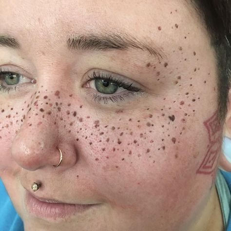 Not so subtle freckles  |  If you are a tattoo artist or permanent makeup artist who can do freckles for me, please let me know. Freckles On Face, Getting Rid Of Freckles, Freckle Tattoo, Tattooed Freckles, Eyebrow Tattoos, Silver Tattoo, Fake Makeup, Freckles Makeup, Fake Freckles