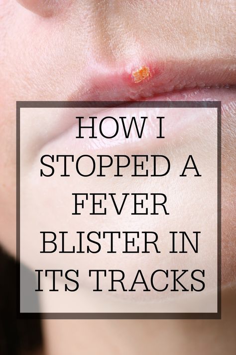 Essential Oils For Fever, Fever Blister Remedy, Remedies For Fever, Blister Remedies, Blister On Lip, Home Remedies For Fever, Natural Remedies For Fever, Fever Blister, Essential Oils For Colds