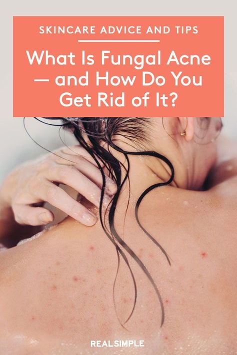 What Is Fungal Acne—and How Do You Get Rid of It? | Do you have a stubborn breakout on your chest, arms, or back that just won't give in to acne medication? You may have fungal acne (don’t worry, it’s not as gross as it sounds). A dermatologist shares skincare tips on how to treat and help prevent fungal acne. #beautytips #realsimple #skincare #makeuphacks #bestmakeup Anti Fungal Remedies For Skin, Clear Back, Nizoral For Fungal Acne, Skin Care For Fungal Acne, Fungal Acne Products, Get Rid Of Fungal Acne, How To Get Rid Of Fungal Acne, Arm Acne, Back Acne Remedies