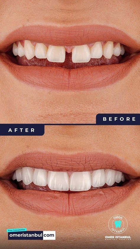 #WhatsOralCare Tooth Gap Aesthetic, Gap Teeth Aesthetic, Teeth Gaps Aesthetic, Big Front Teeth, Gap Between Teeth, Teeth Gap, Teeth Veneers, Gap Band, Teeth Aesthetic