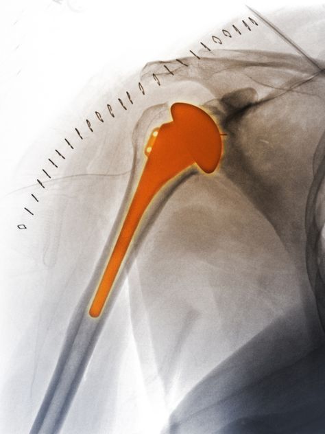 Reverse Shoulder Replacement Surgery, Reverse Shoulder Replacement, Surgery Prep, Shoulder Surgery Recovery, Shoulder Replacement Surgery, Rotator Cuff Surgery, Rotator Cuff Tear, Physical Therapy Exercises, Shoulder Surgery