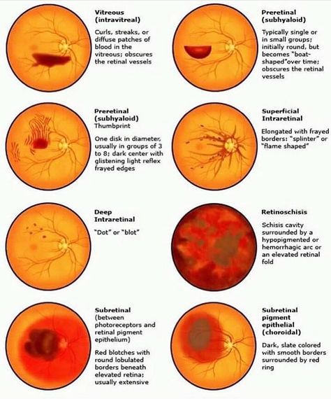 Therése Optom on Instagram: “Retinal pathology cases!” Opthalmic Technician, Exam Template, Eye Health Facts, Optometry Education, Eye Retina, Optometry School, Eye Facts, Eye Anatomy, Medicine Notes