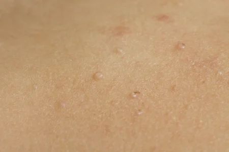 Molluscum contagiosum: Signs and symptoms Molluscum Contagiosum, Pediatric Nursing, Signs And Symptoms, The Signs, Pediatrics, Nursing, Disease, Signs, Health