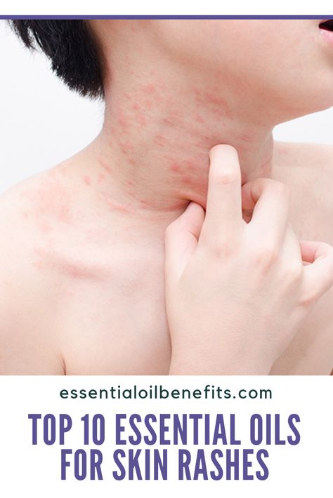 Essential Oil Recipes For Skin Rashes, Essential Oil For Skin Irritation, Essential Oils For Rashes Skin, Essential Oils For Itching Skin, Natural Remedies For Rashes, Essential Oils For Itchy Rash, Essential Oils For Rash And Itching, Essential Oils For Itchy Skin, Essential Oils For Rash