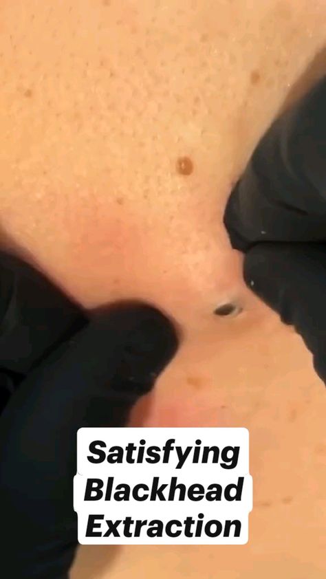 Satisfying Blackhead Removal Blackheads Removal Homemade, Skin Extraction, Blackheads Removal Satisfying Videos, Black Head Removal Video Nose, Pimple Poppìng, Huge Blackheads, Blackheads Removal Cream, Ear Pimple, Pimple Removal