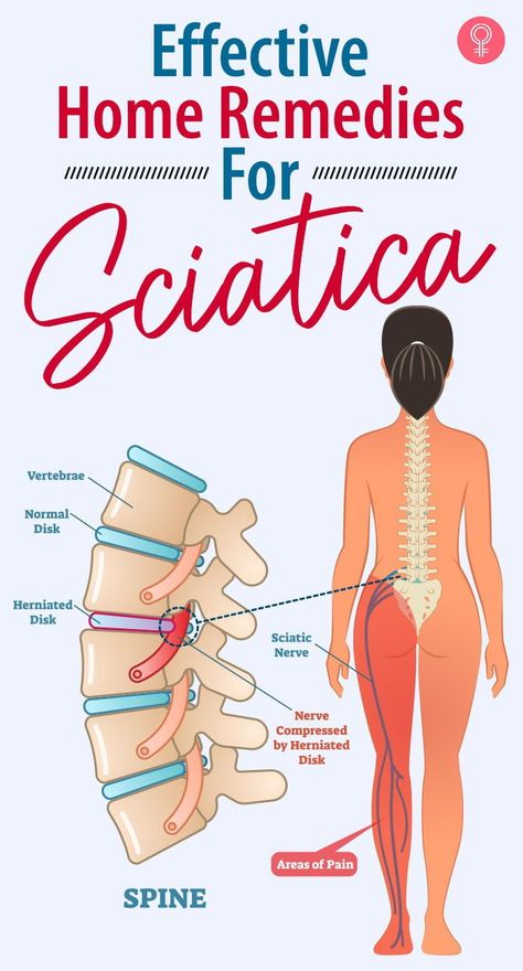 Sciatic Nerve Exercises, Nerve Pain Remedies, Sciatic Nerve Pain Relief, Pain Relief Remedies, Sciatica Exercises, Sciatica Pain Relief, Sciatica Relief, Back Pain Remedies, Nerve Pain Relief