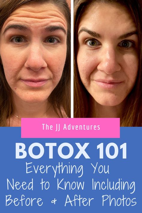 Places To Get Botox On Face, After Botox Care, Botox For Beginners, Botox 11 Lines Before After, Botox Timeline, Botox Placement Chart, Forehead Botox Before And After, Before And After Botox Pictures, Botox Before After