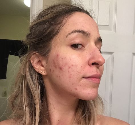 The Secret that Cleared My Severe, Hormonal, Cystic, Itchy, Adult Acne after 17 Years – Part 2 – Brooke's Beauty Bazaar Cystic Hormonal Acne, Hormonal Acne Recipes, Hormonal Acne Routine, Cystic Acne Routine, How To Stop Hormonal Acne, Hormonal Acne Tips, Acne Diet Plan Hormonal, How To Get Rid Of Cystic Acne, Clear Up Acne Fast