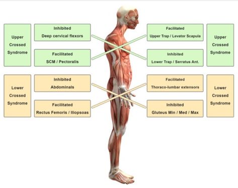 Upper Cross Syndrome, Sternocleidomastoid Muscle, Gluteal Muscles, Rounded Shoulders, Pectoral Muscles, Upper Back Pain, Shoulder Muscles, Strengthening Exercises, Poor Posture