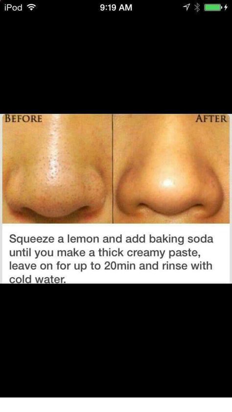 Obličejové Masky, Exposed Skin Care, Blackhead Remover Diy, Diy Acne, Smink Inspiration, Skin Pores, Skin Remedies, Dr Oz, Lifestyle Tips