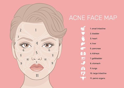 While aches and pains are common signs of illness, Emma has revealed how your face can be a reflection of your inner health too (stock image) Doterra Acne, Gesicht Mapping, Acne Face Map, Face Map, Face Mapping Acne, Pimples On Face, Face Mapping, Acne Face, Acne Face Wash