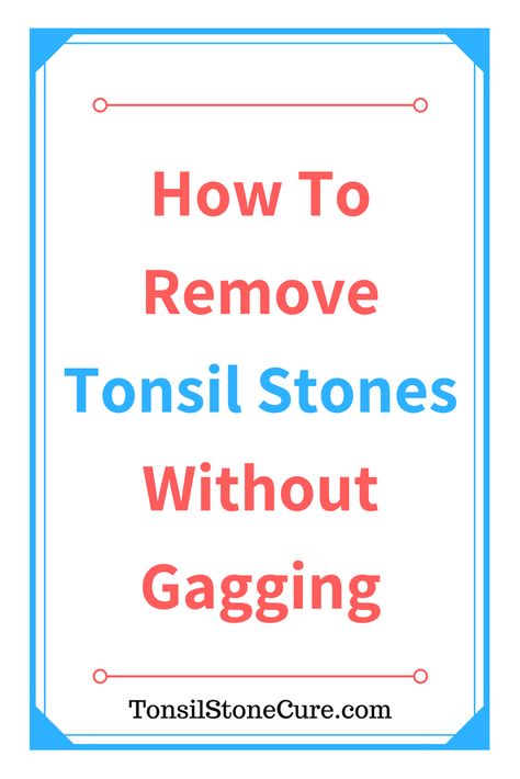 Throat Stones Remedies, Tonsil Stone Remedies, Tonsil Stones What Causes, How To Get Rid Of Tonsil Stones, Tonsil Stones Removal, Throat Health, Tonsil Stone Removal, Tonsil Stone, Healthy Lifestyle Quotes