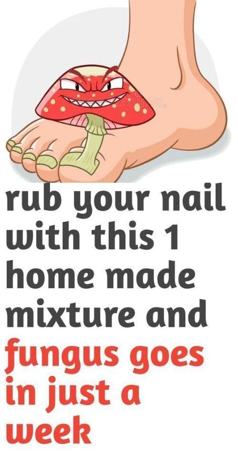 People go crazy for his recipe! toenail fungus remove in just one week!#killsnail #treatmentfungus #nailfungus #toenailfungus #fungus #fungustretment #fungustoenail Fungal Infection Remedies, Toenail Fungal Infection, Toenail Removal, Diy Medicine, Toenail Fungus Remedies, Types Of Fungi, Nail Fungus Remedy, Fungal Nail, Ingrown Toe Nail