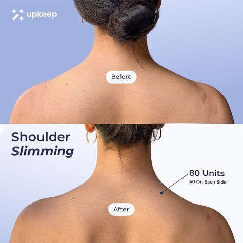 Slimmer shoulders with 80 units of Botox! 40 on each side for an elongated neck, corrected posture, and engaged abs! Book on Upkeep: your go-to app for effortlessly booking on-demand medical aesthetics treatments at trusted providers near you! Book at vetted MedSpa’s near you on the Upkeep app! Available on iOS & Google Play! # botox aesthetic Botox injections sites Botox before after Botox face Botox aesthetic Shoulder Botox Before And After, Barbie Botox Before And After, Skin Before And After, Neck Botox Before And After, Slimmer Shoulders, Botox Aesthetic, Botox Injection Sites, Botox Before And After, Aesthetic Nurse