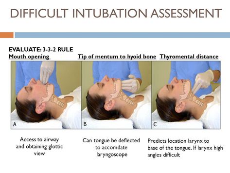 THE DIFFICULT AIRWAY MANAGEMENT IN ADULT CRITICAL CARE 5 MAY 2014 J MATSHE. - ppt download Airway Management, Best Masks, Critical Care, Paramedic, Assessment, Medicine, How To Plan