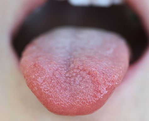 Transient lingual papillitis, aka lie bumps or liar’s tongue, happens when something riles up bumps on your tongue that contain your taste buds. Lie Bumps On Tongue Remedy, Lie Bumps On Tongue, Inflamed Taste Buds, Blister On Tongue, Bumps On Tongue, Tongue Taste Buds, Sore Tongue, Ulcer On Tongue, Healthy Tongue