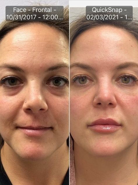 Lipfiller Before After, Check Filler Before And After, Smile Lines Filler Before And After, Natural Lip Fillers Before And After, Nasal Fold Filler Before And After, Lip Injections Before And After 1ml, Filler Nasolabial Folds, Filler In Cheeks Before And After, Botox Under Eyes Before And After