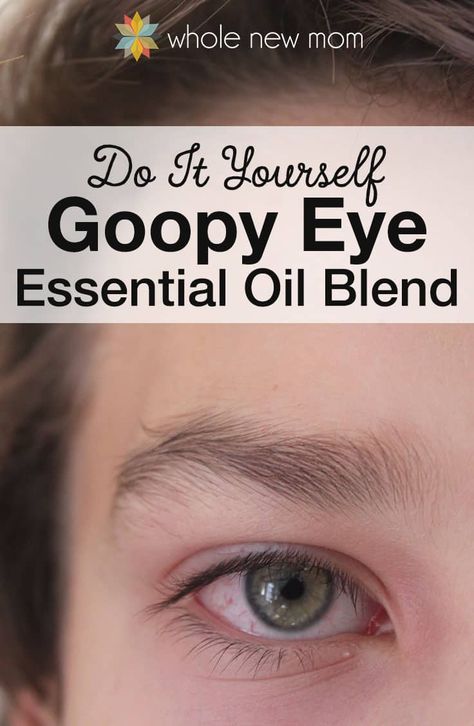 DIY Goopy Eye Natural Remedy Essential Oils Blend Pink Eye Essential Oils, Pink Eye Remedy, Goopy Eyes, Natural Pink Eye Remedy, Pinkeye Remedies, Essential Oils For Colds, Essential Oils For Headaches, Essential Oil Remedy, Oil Remedies