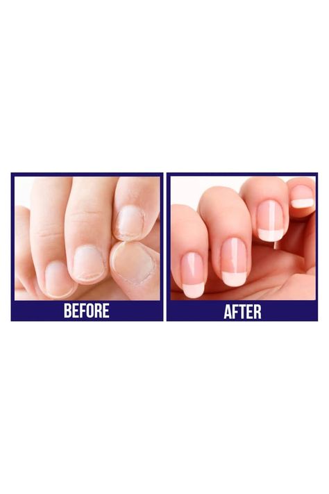 Nail Ridges, Peeling Nails, Nail Problems, Weak Nails, Damaged Nails, Cream Nails, Nail Growth, Nail Strengthener, Nail Fungus