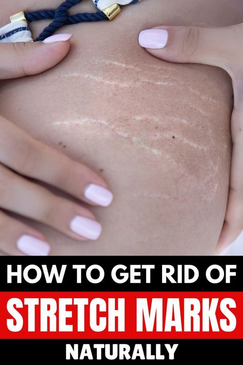 Stretch marks are those fine lines or disfiguring lesions that are very common on the body parts such as butts, hips, thighs, stomach and upper breasts. Here are the best home remedies, which are totally safe and using them will make your stretch marks fade away. #beauty #skin #skincare #stretchmarks Dark Buttocks Remedy, How To Get Rid Of Strech Marks On Hips, Strech Marks, Stretch Mark Remedies, Marks Cream, Stretch Mark Removal, Stretch Mark Cream, Baking Soda Shampoo, Stretch Mark