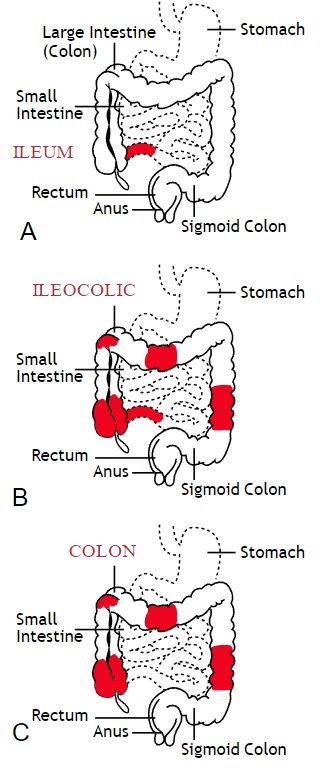 Med Surge, Crohns Diet, Gi System, Sigmoid Colon, Restless Leg, Types Of Diseases, Dental Cavities, Inflammatory Bowel, Gastrointestinal Disorders