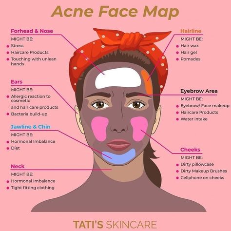 There's not just one reason that you get acne, as there's so much that goes into it. This is a general map to give you an idea of what could possibly be the culprit for your breakouts. Remember, among other things, regular exfoliation, limiting sugar intake, and changing your pillowcase often can aid in reducing your breakouts. Reasons For Acne, Acne Face Map, Face Map, Acne Reasons, Diy Natural Beauty Recipes, Face Mapping Acne, Face Mapping, Acne Face, Natural Beauty Recipes