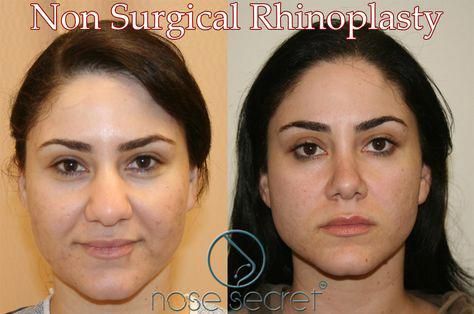 Non Surgical Nose Job, Rhinoplasty Nose Jobs, Rhinoplasty Before And After, Lip Art Makeup, Wide Nose, Nose Surgery, Celebrity Plastic Surgery, Nose Contouring, Nose Shapes