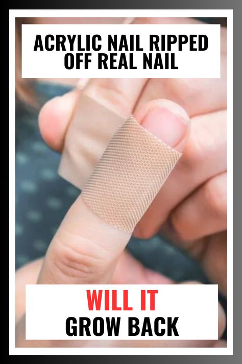 It can be quite an alarming and painful experience when you accidentally rip off your acrylic nail and take a chunk of the real nail with it. If you’re like most people, you may be wondering if your acrylic nail ripped off real nail, will it grow back, or what your options are to restore your natural nails? In this post, we’ll discuss whether a ripped off nail can grow back and how to make sure they do so quickly and effectively. Fix Broken Nail, Nail Falling Off, Cracked Nails, Nails After Acrylics, Weak Nails, How To Grow Nails, Nail Repair, Damaged Nails, Broken Nails