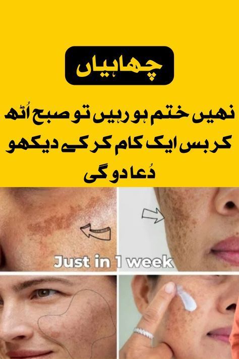 very effective remedy of morning routine of feckles ladies for removing freckles and dark spots Getting Rid Of Freckles, Freckle Remover, Dear Zindagi Quotes, Dear Zindagi, Embroidery Fashion Detail, Fat Burner Drinks, Beauty Tips For Skin, Baby Frocks Designs, Good Health Tips