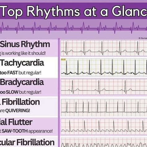 shanu.ECG on Instagram: "Here is some major ECG/EKG Rhythms🤩 Post from @registerednursern_com  . Follow us for more information 👇 @qknowledge.of.ecg  @knowledge.of.ecg  @knowledge.of.ecg  @knowledge.of.ecg  @knowledge.of.ecg  . . . . .. . . #ecg #ekg #cardiology #ecginterpretation #electrocardiograma #electrocardiogram #nursing #cardiologista #healthy #interpretation #heart #nurse #knowledgeofecg #hearts #heartbeat #ccu #cardio #cardiovascular #quiz #cardiologia #physicianassistant #medical #treatment #physician #heartrate #medicalstudent #doctor #hospital #cardiologists #myocardium" Ekg Rhythms, Ecg Interpretation, Doctor Hospital, Study Tips For Students, Minions Wallpaper, Physician Assistant, Medical Assistant, Cardiology, Medical Students