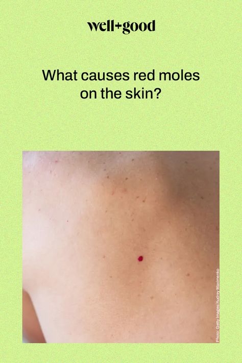 moles on skin Mole On Breast, Red Moles On Skin, How To Remove A Mole On Face, Home Remedy To Remove Moles, A Mole On The Face, Mole Meaning In Body Life, Mole Meaning, Moles On Face, Red Moles