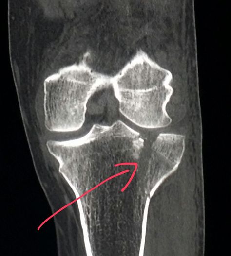 #Knee #CT #scan shows a #fracture (#tibial #plateau) in a #patient who was #hit by a #car. #radiologist #radiology #trauma #injury #pain #MVA #Caraccident Mcl Tear, Acl Tear, Hit By A Car, Diagnostic Imaging, Ct Scan, Radiology, A Car, Surgery, Quick Saves