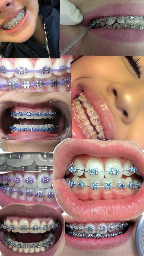 Braces Colors Combinations, Pink Braces, Bijoux Piercing Septum, Cute Braces Colors, Pretty Teeth, Braces Tips, Getting Braces, Cute Braces, Brace Face