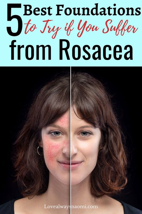 Best Foundations for Rosacea Best Foundation For Redness, Foundation For Redness, Red Blotchy Skin, Best Foundation For Combination Skin, Redness On Face, Foundation For Sensitive Skin, Primer For Dry Skin, Sensitive Skincare, Full Face Of Makeup