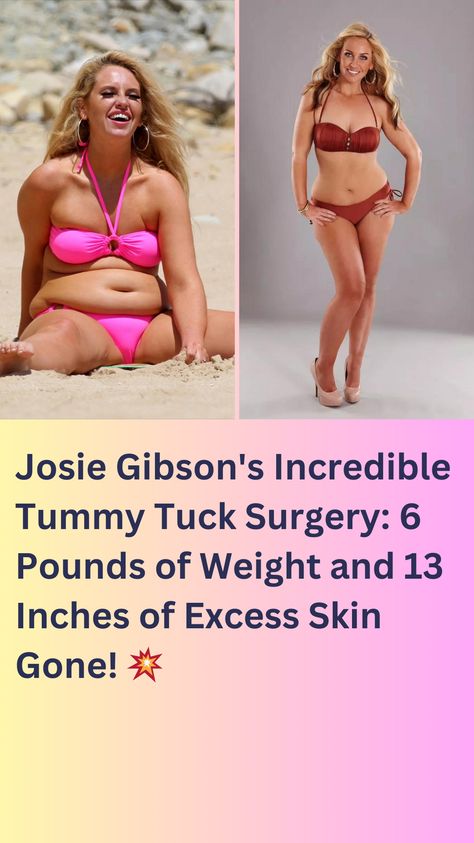 Josie Gibson's tummy tuck surgery removed a staggering 6 pounds of weight and 13 inches of excess skin! Learn about her health concerns and the incredible results in this article! 😱 Excess Skin, This Morning, Gibson, Surgery, The Incredibles, Skin, Health