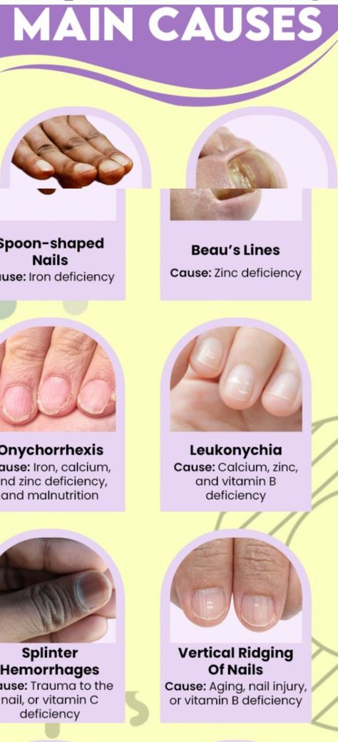 Nail Symptoms, Fingernail Health, Nail Disorders, Nail Discoloration, Nail Remedies, Nail Conditions, Stronger Nails, Weak Nails, Fungal Nail